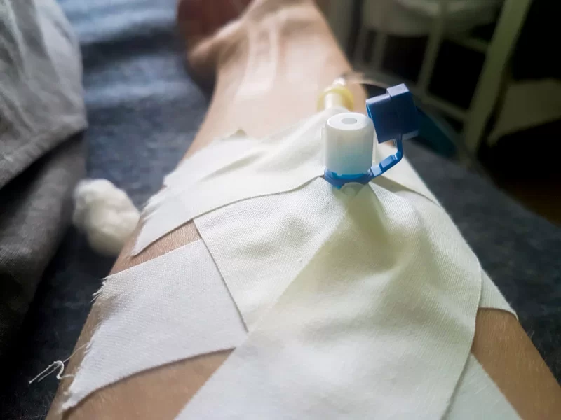 Периферический венозный катетер в вене руки человека